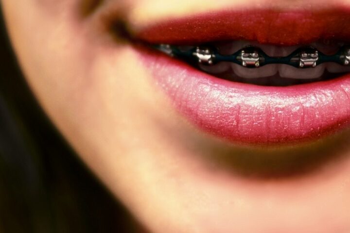 que significa cuando sueñas que se caen los dientes con brackets